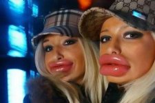 botox-lips.jpg