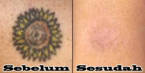 hasil-dari-remover-tattonox.jpg