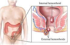 hemorrhoids.jpg